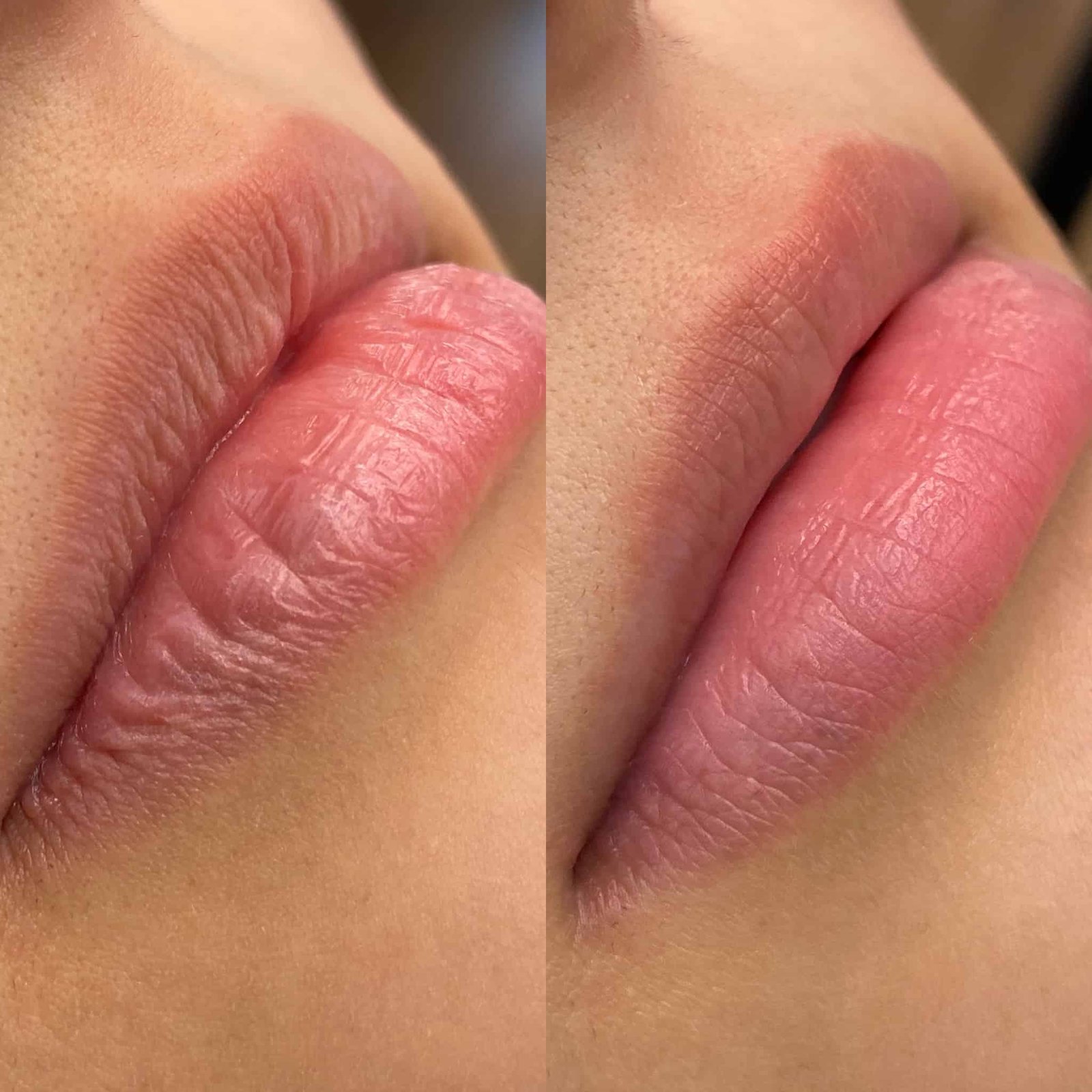 procedure-hydra-lips-img-1